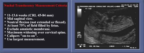 nuchal fold thickness normal measurement|nuchal fold vs translucency.